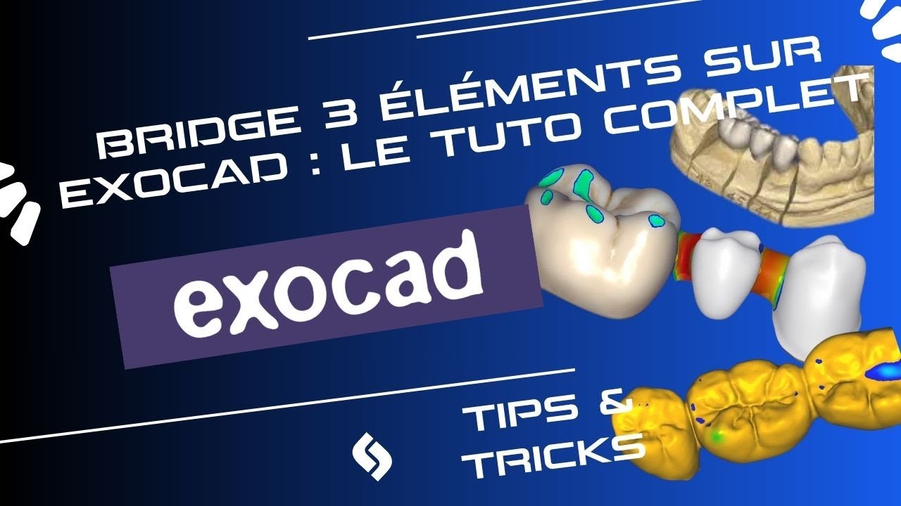 Bridge 3 éléments sur Exocad : le tuto complet!