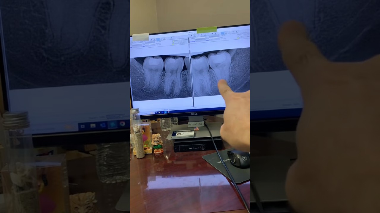 Два эндодонтических лечения. #стоматологи #apexdental #стоматологическаяклиника #гигиенист #лечен...