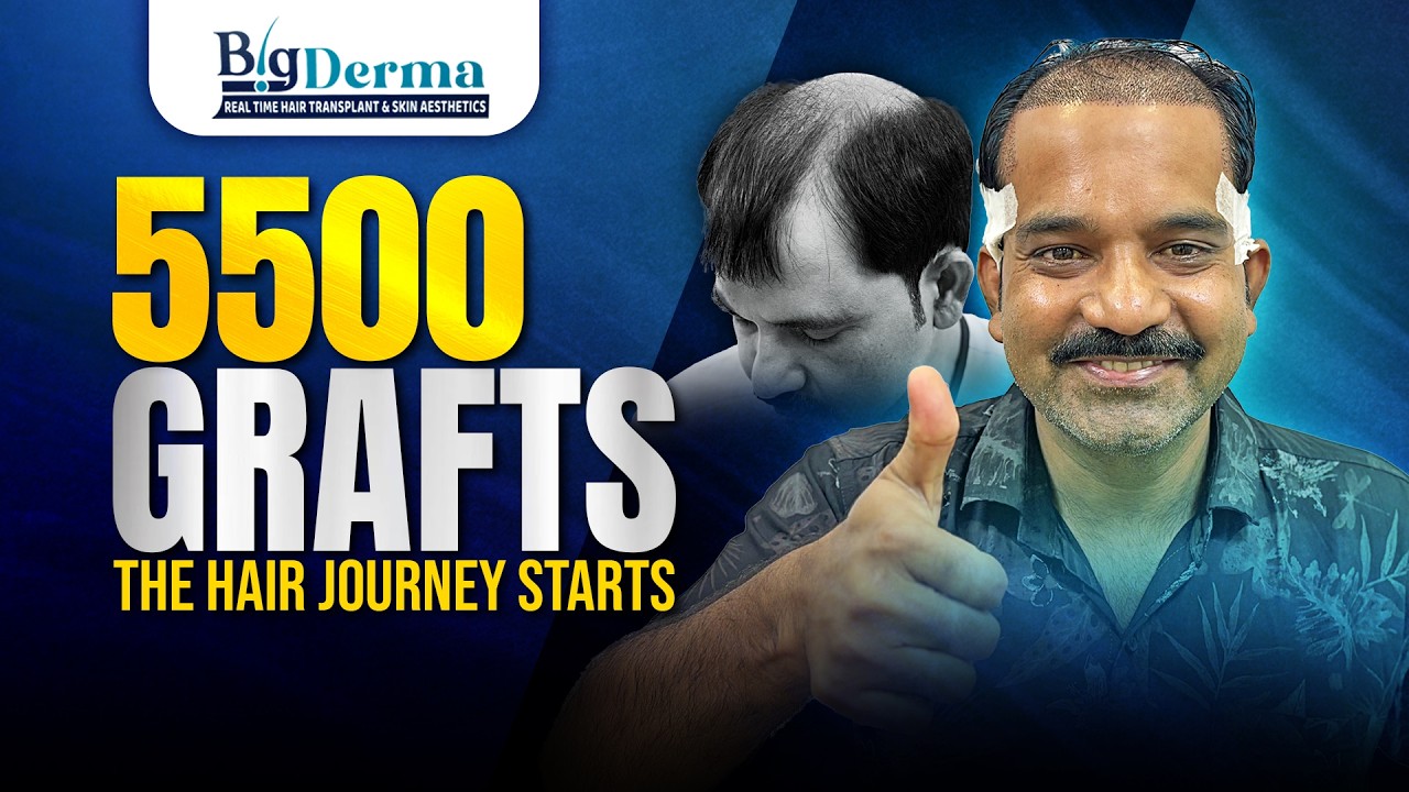 5500 Grafts Hair Transplant | Hair Transplant Clinic in Kolkata