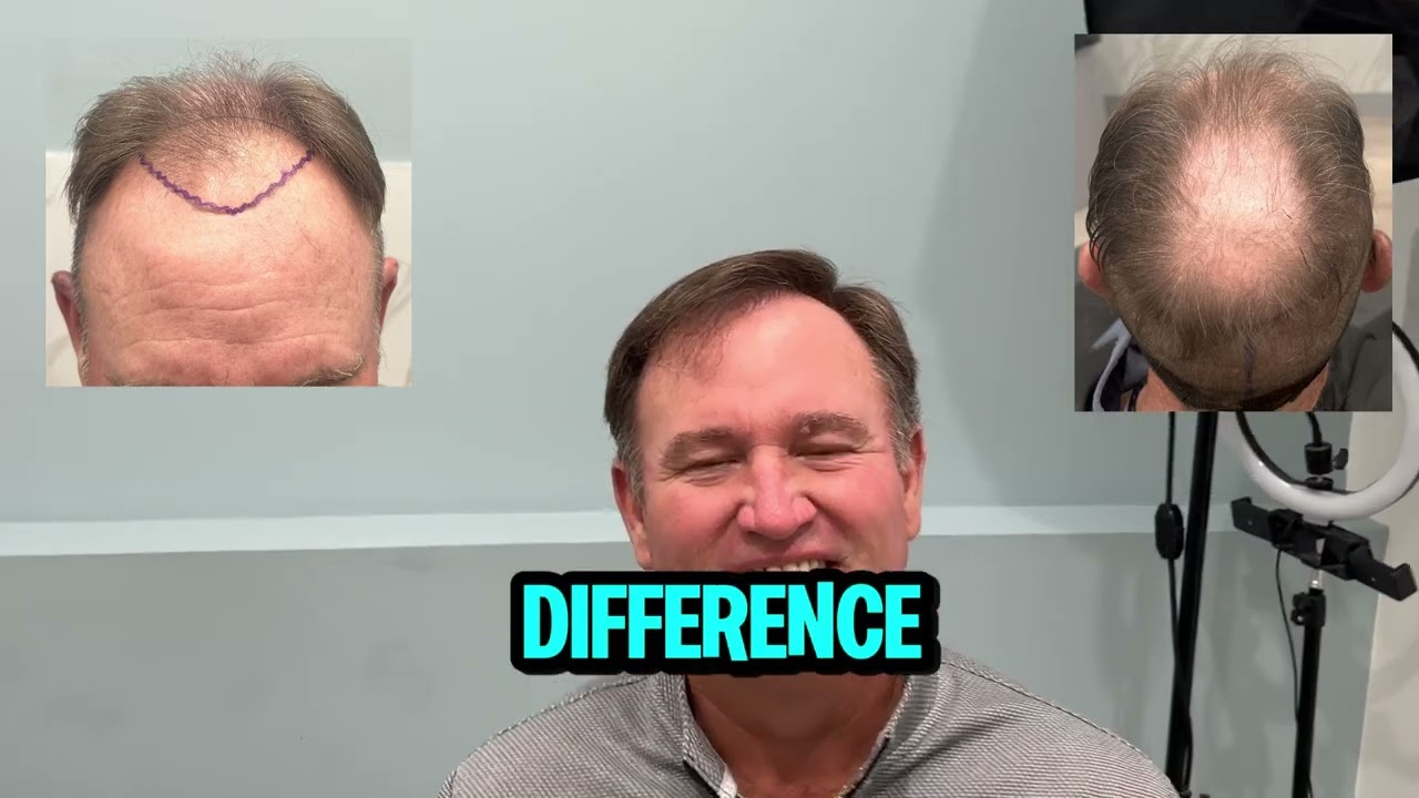 Class 6 hairloss transformation 5,700 grafts FUE - Dr. Sean Behnam