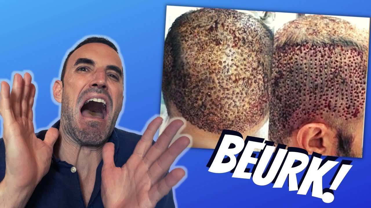 Évitez Cette Technique de Greffe de cheveux sinon 💥😱☠️