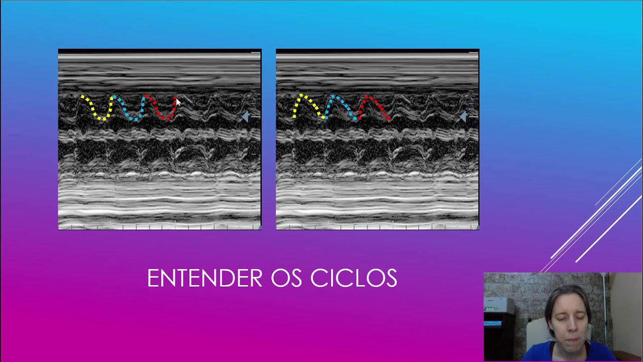 Modo M e frequência cardíaca fetal - Dica da Semana