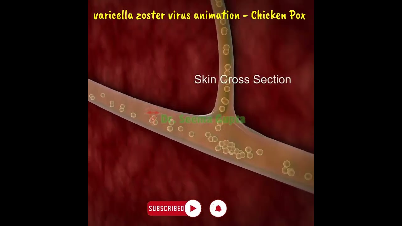 varicella zoster virus animation - What Causes Chickenpox? Best Learning Videos For Kids #shorts