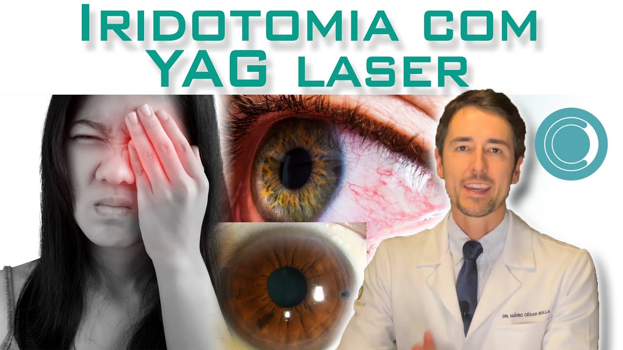 Iridotomia com YAG laser.