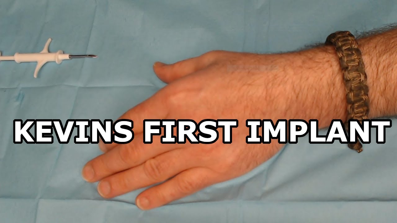 #18 - Stabby Stabby Time (Kevin gets his first implant)
