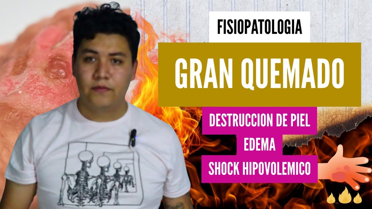 FISIOPATOLOGIA del PACIENTE GRAN QUEMADO | Quemaduras | Anatomia en Enfermeria