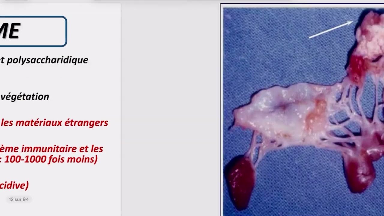 🔴 Extrait de séance en direct — Objectif 25 : Endocardites infectieuses
