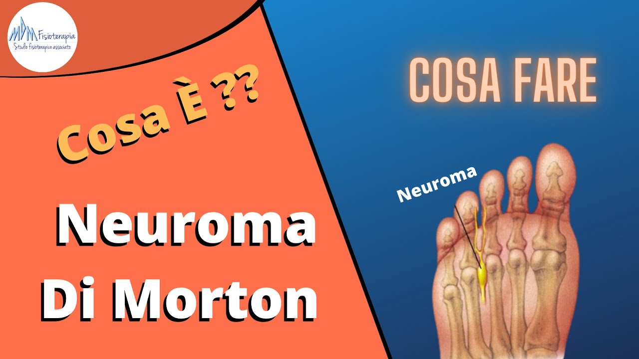 Neuroma di Morton cosa è, come si cura