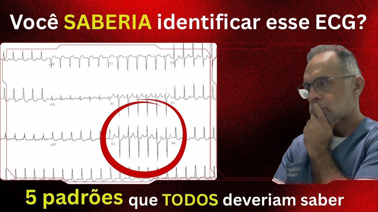 “5 Padrões de ECG Que Todo Mundo Precisa Dominar (E Como Não Errar Nunca Mais!)”