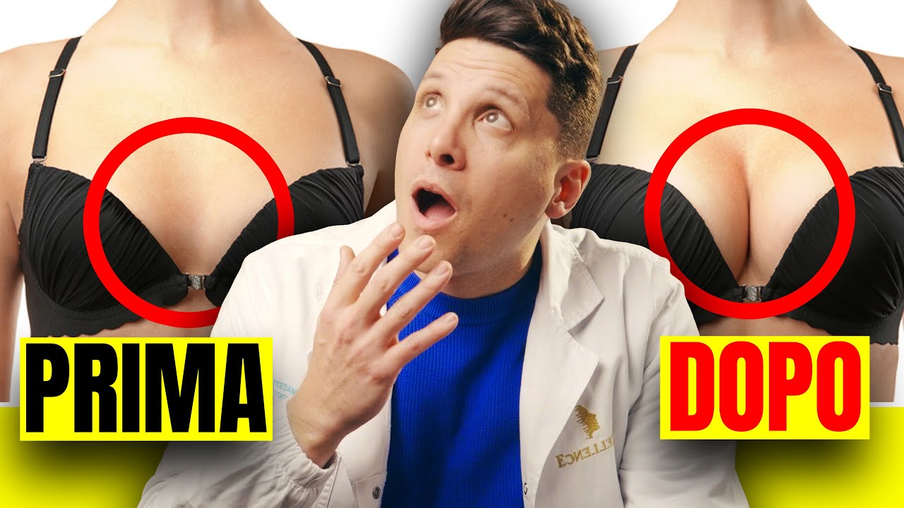 Mastoplastica Additiva: Prima e Dopo - Dott Claudio Maestrini