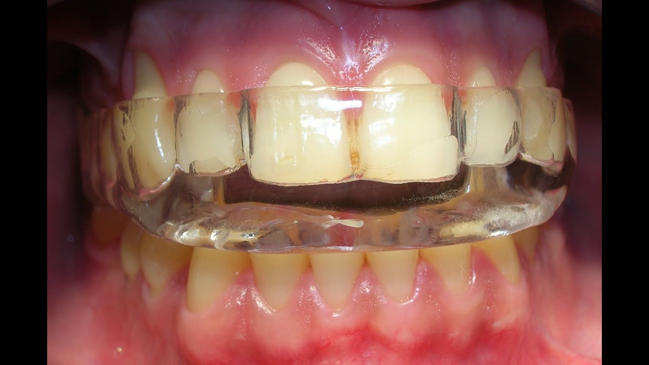 Placa miorrelajante, prueba de la din&aacute;mica mandibular