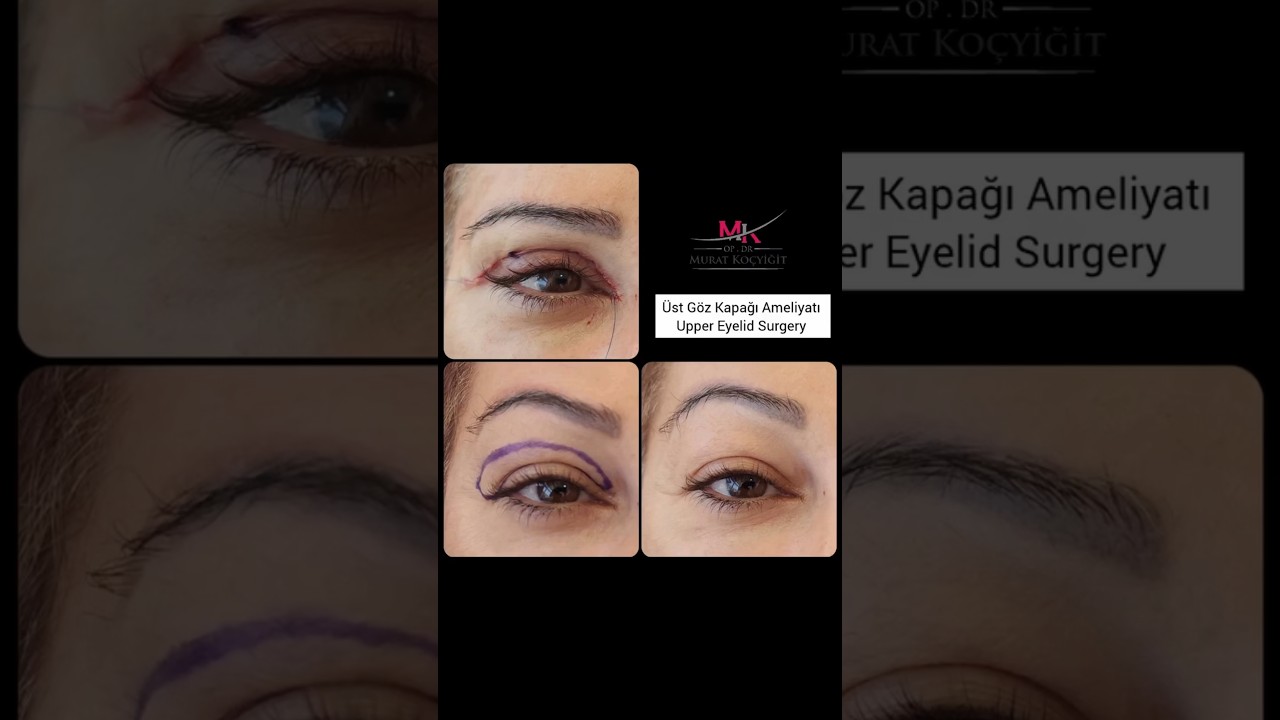 Üst Göz Kapağı Ameliyatı, Upper Eyelid Surgery