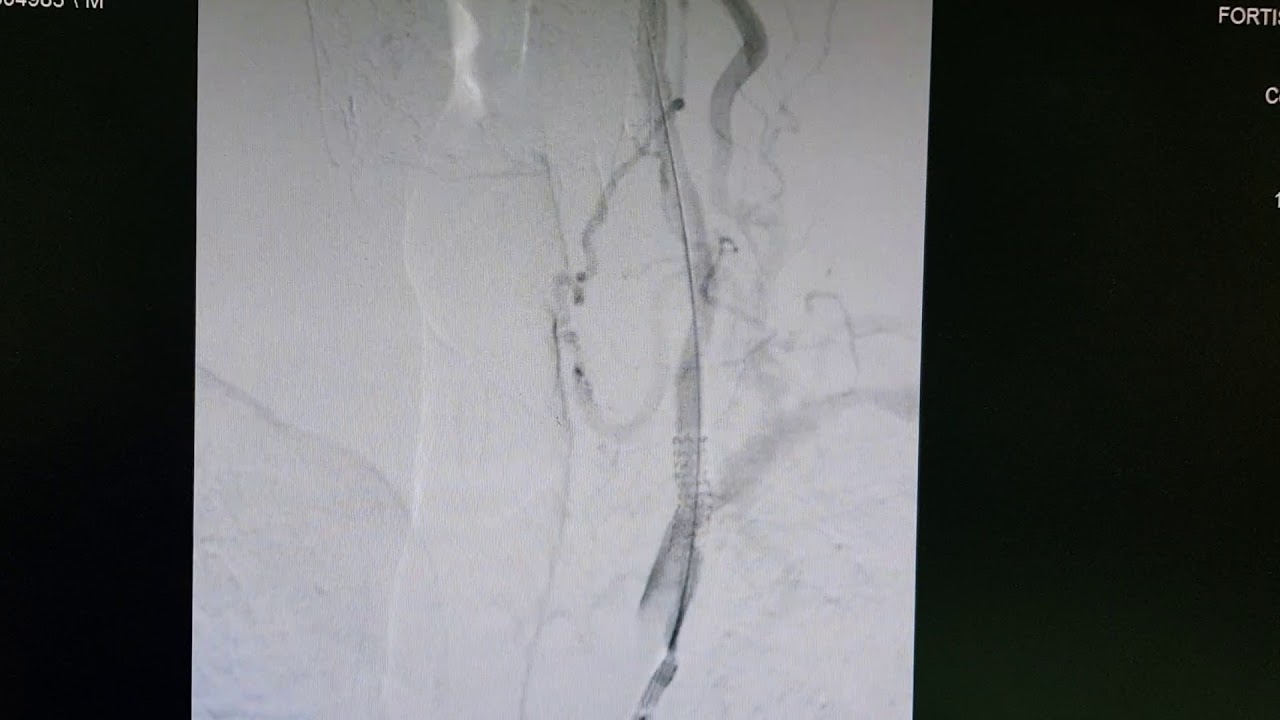 Bilateral vertebral artery ostial angioplasty and stenting
