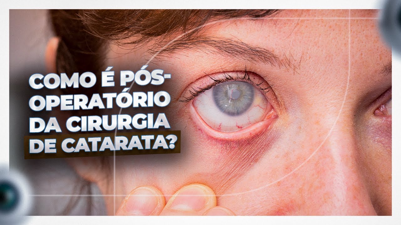 ASSIM É O PÓS OPERATÓRIO DA CIRURGIA DE CATARATA | Dr. Gustavo Bonfadini