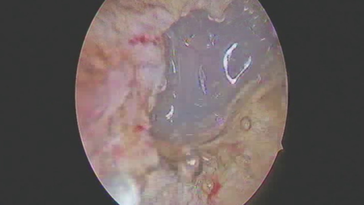 adenomiosi  by Eleonora Castellacci Ginecologia Isteroscopia