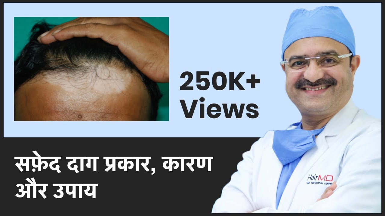 All About Vitiligo/Leucoderma (सफ़ेद दाग प्रकार, कारण और उपाय) | ClearSkin, Pune | (In HINDI)
