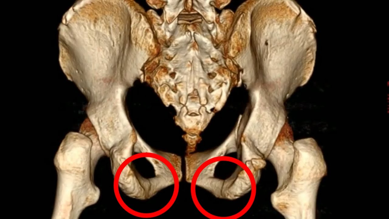 Pubic bone superior and inferior rami fracture