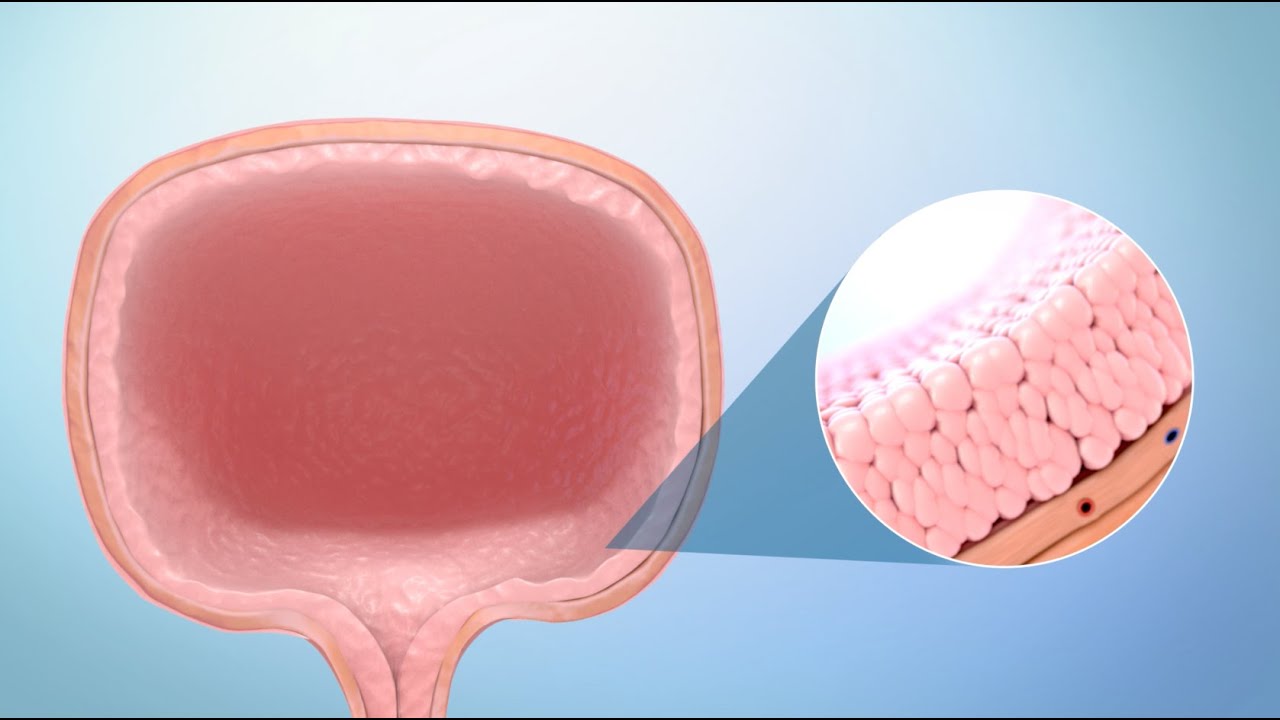 Treatment for Bladder Cancer