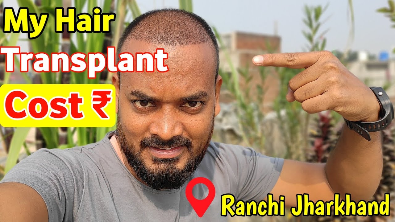 My Hair Transplant Cost ₹ Full Details || Hair Transplant in Ranchi Jharkhand || Transplant Journey