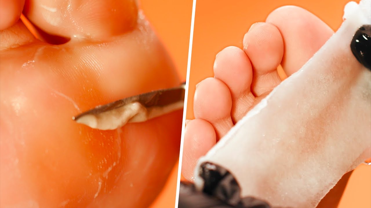 Extremely SATISFYING Calluspeeling + Reflexology Foot Care