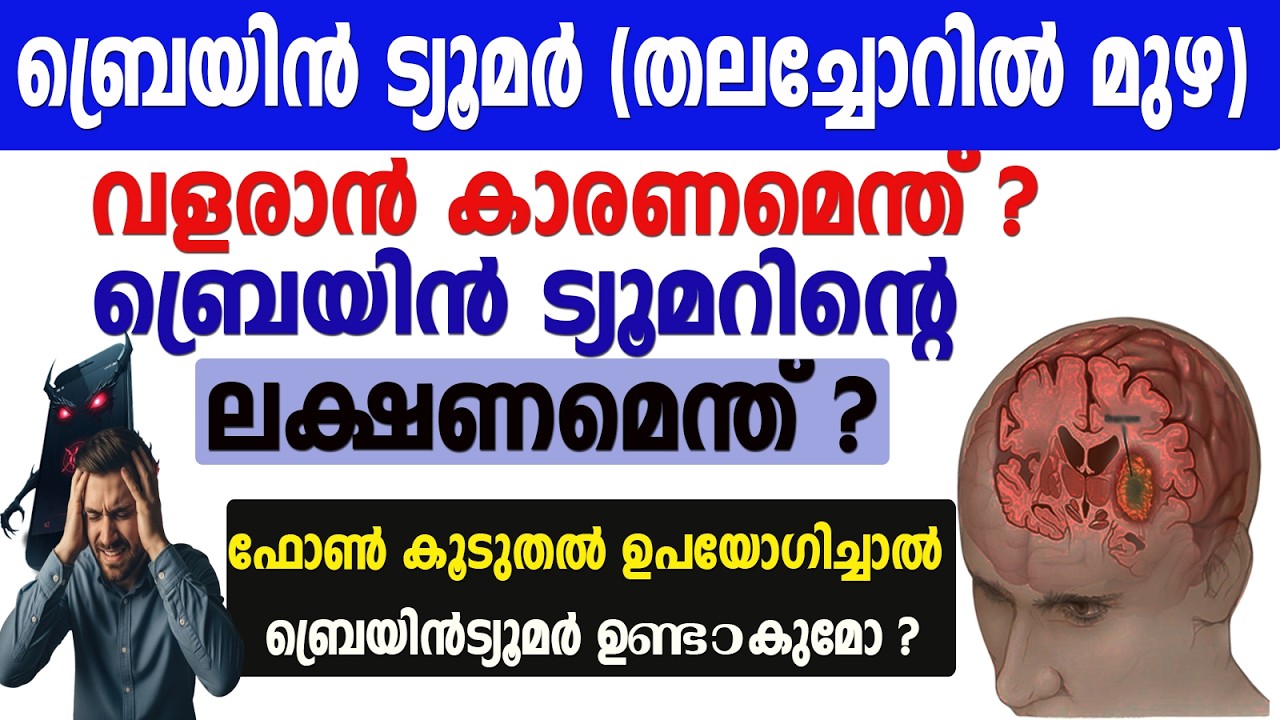 ബ്രെയിൻ ട്യൂമർ (തലച്ചോറിൽ മുഴ) വളരാൻ കാരണമെന്ത് ?  ട്യൂമർ തുടക്കത്തിലേ ഉള്ള ലക്ഷണങ്ങൾ എന്തെല്ലാം ?