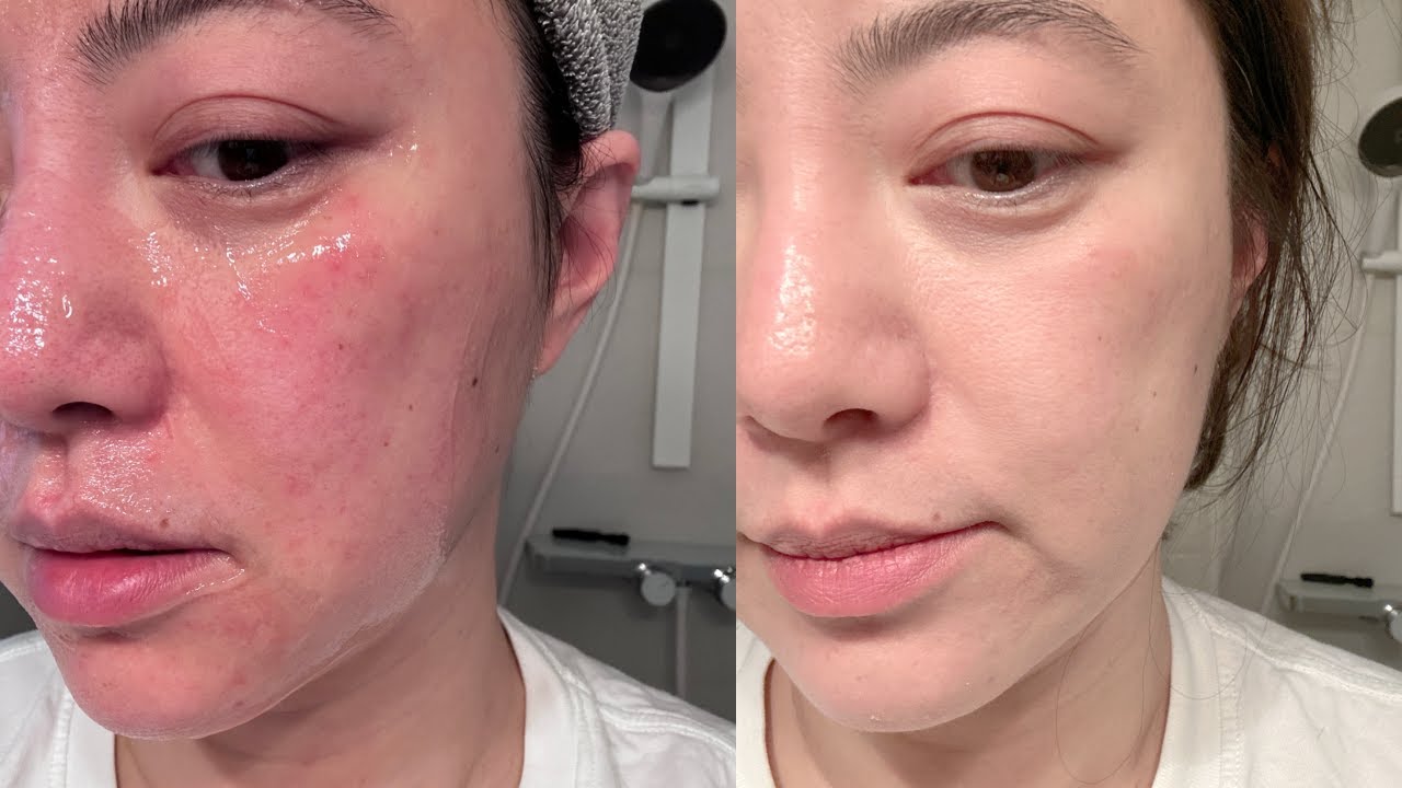 烂脸如何急救？如何维稳？
