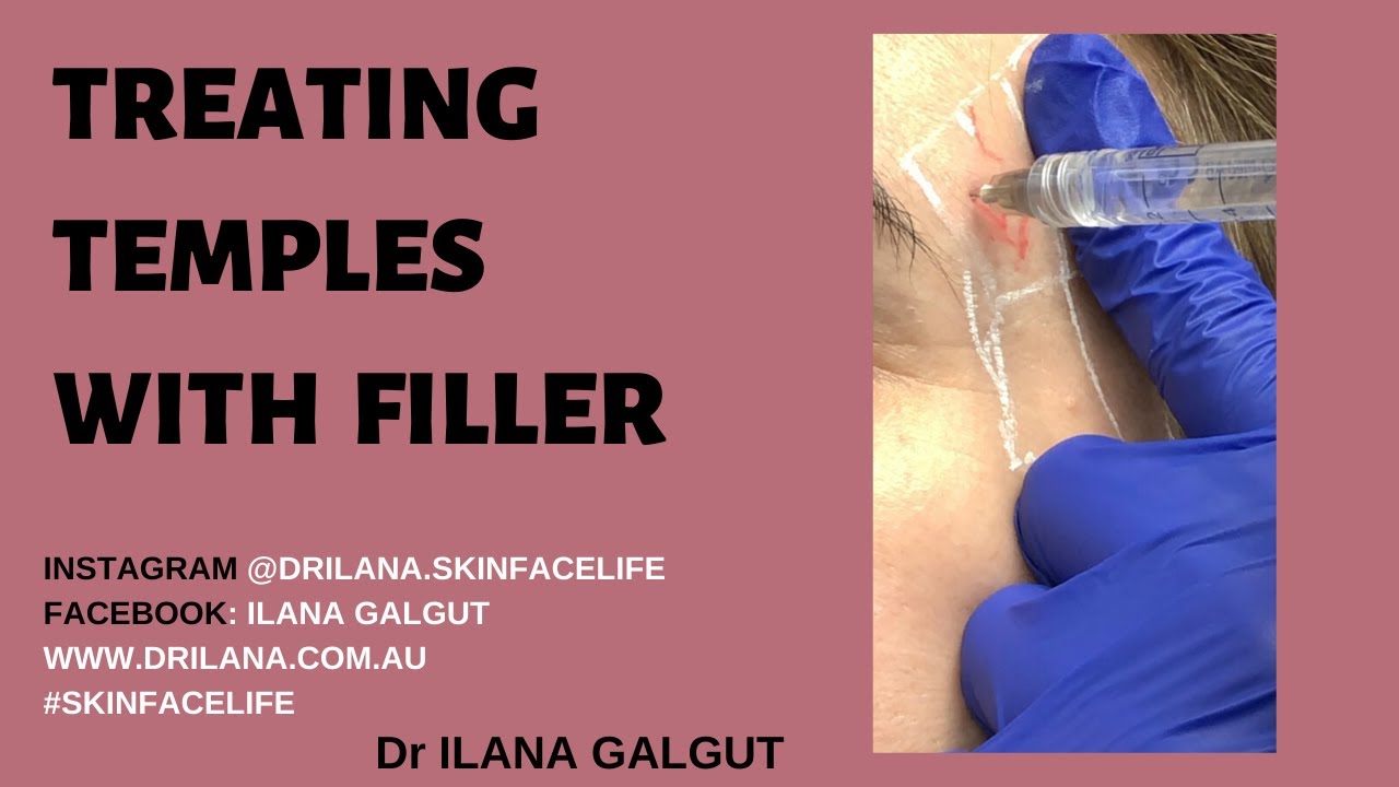 How to treat the temples with dermal filler