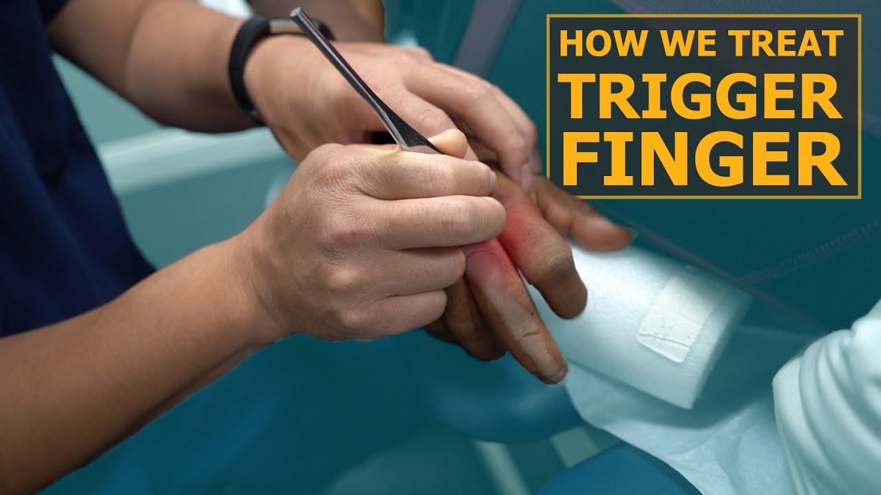How We Treat Trigger Finger | Physical Therapy