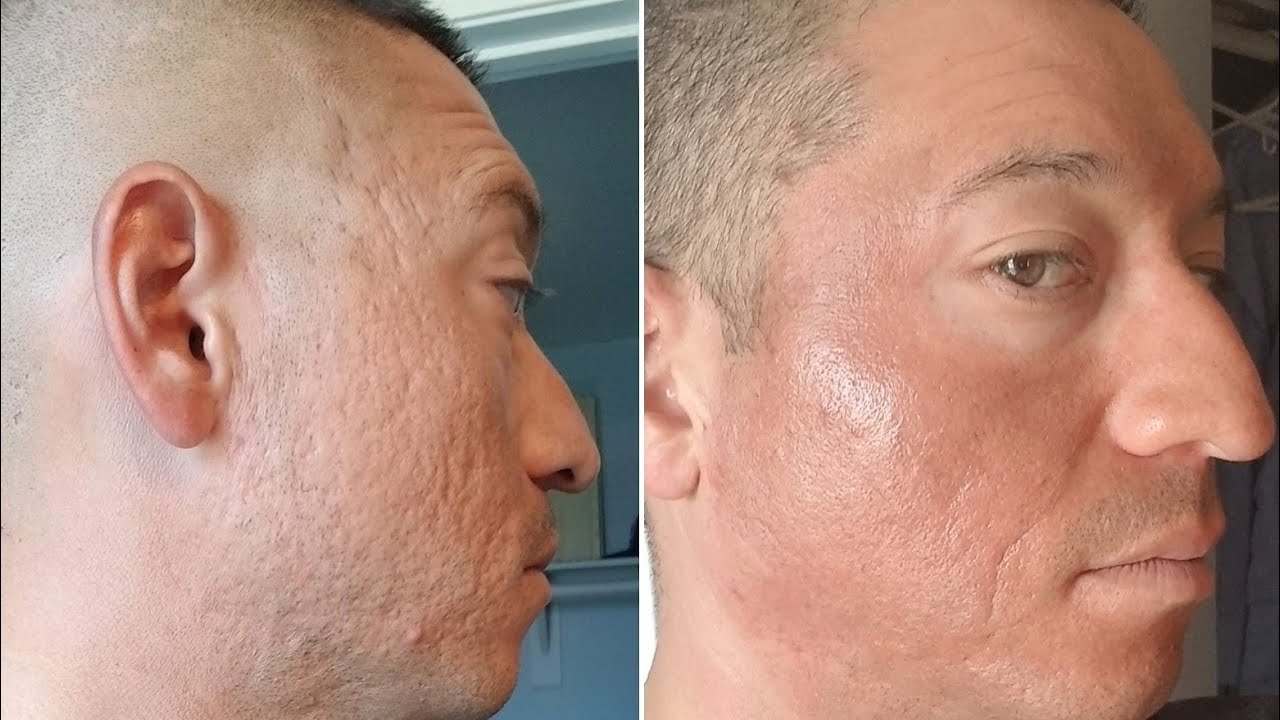 My 1 Year Progress with Dr. Jason Emer for Acne Scars