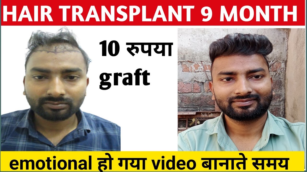 9 month hair transplant result // hair transplant result after 9 month // hair transplant