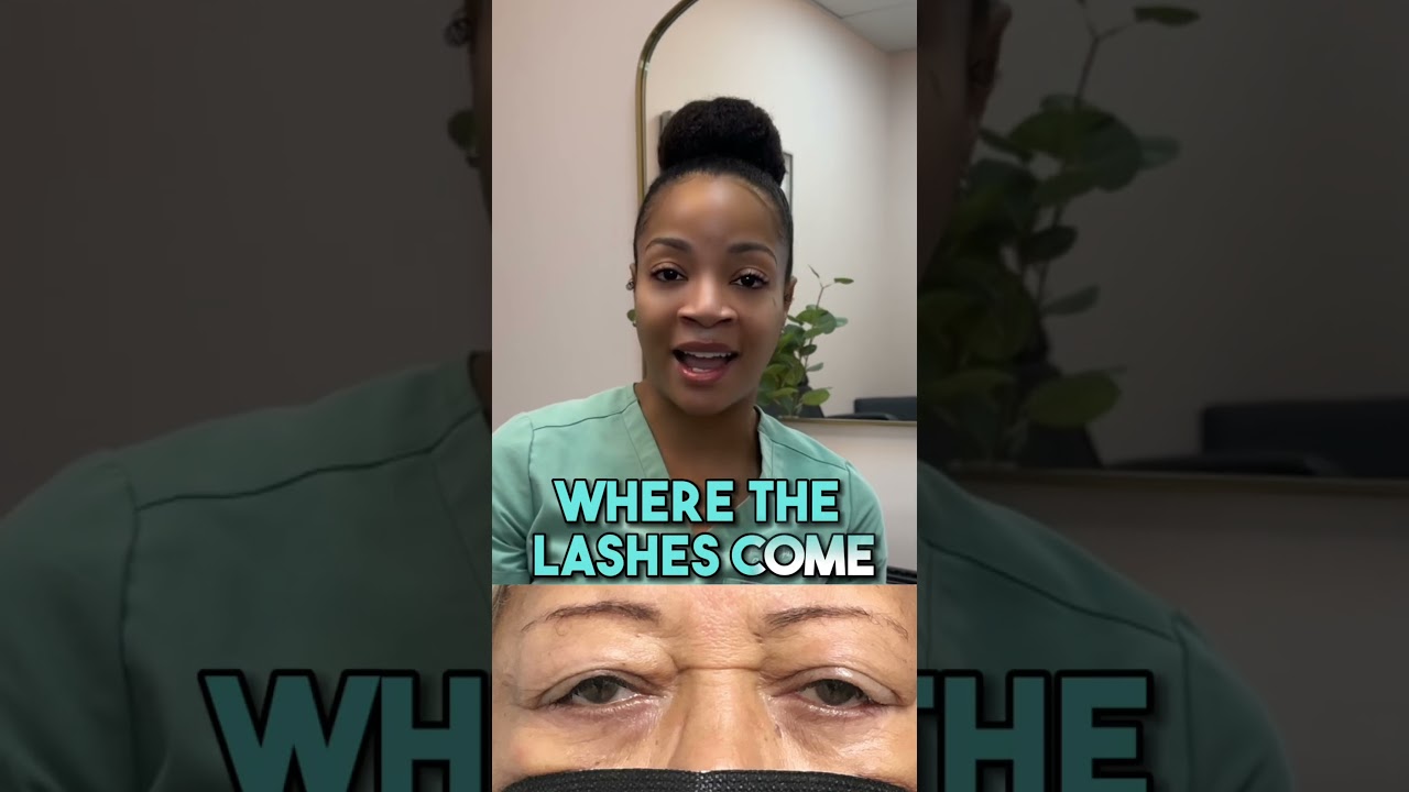 What is Ptosis? #eyelidsurgeon #oculoplastics #htx #oculoplasticsurgeon #houston #ophthalmologist