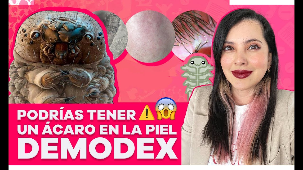 ¡NO ES ACNÉ! ES DEMODEX (ACARO QUE VIVE EN LA PIEL)