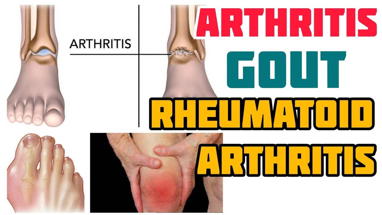 Arthritis, Gout at Rheumatoid Arthritis - Payo ni Doc Gary Sy at Doc Willie Ong #3b