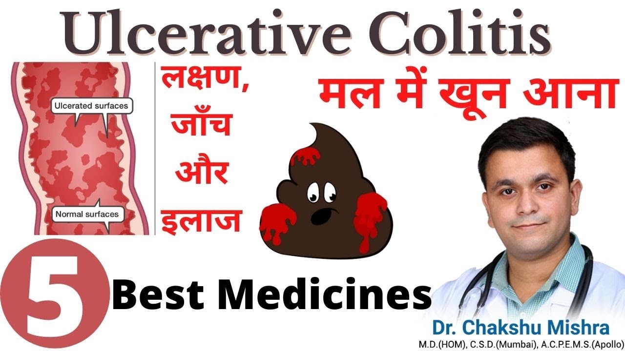 Ulcerative Colitis treatment and symptoms. Best medicine for ulcerative colitis