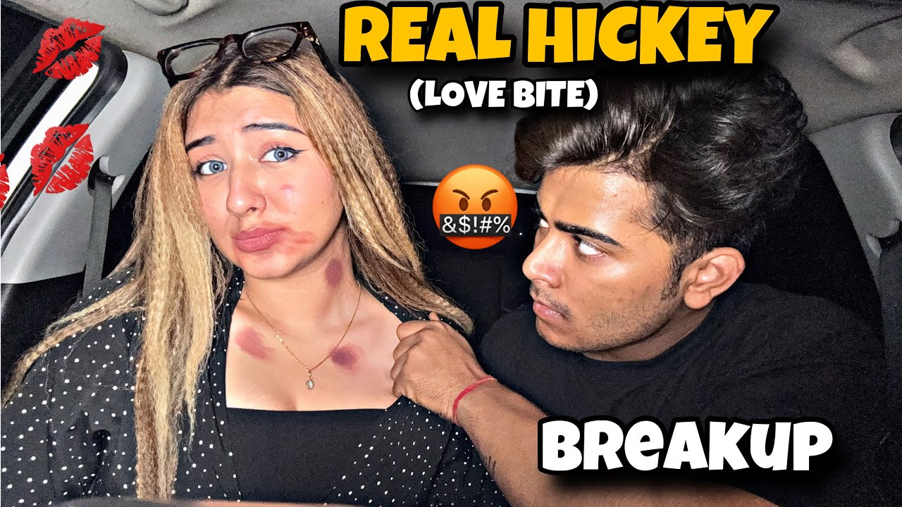 Real Hickey (Love Bite) 💋 Prank On Anmol * He Got Extremely Angry 🤬