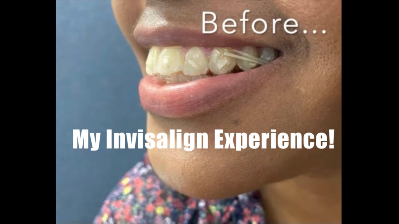 Weight Loss? Total Cost? My Invisalign Experience
