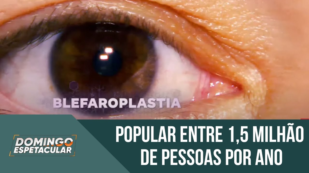 Blefaroplastia: conheça os riscos da cirurgia plástica mais realizada no mundo