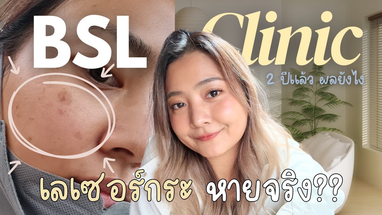 BSL Clinic รักษากระ 60,000 บาท ผ่านมาแล้ว 2 ปี หายจริง? รู้สึกยังไง? แนะนำต่อไหม?