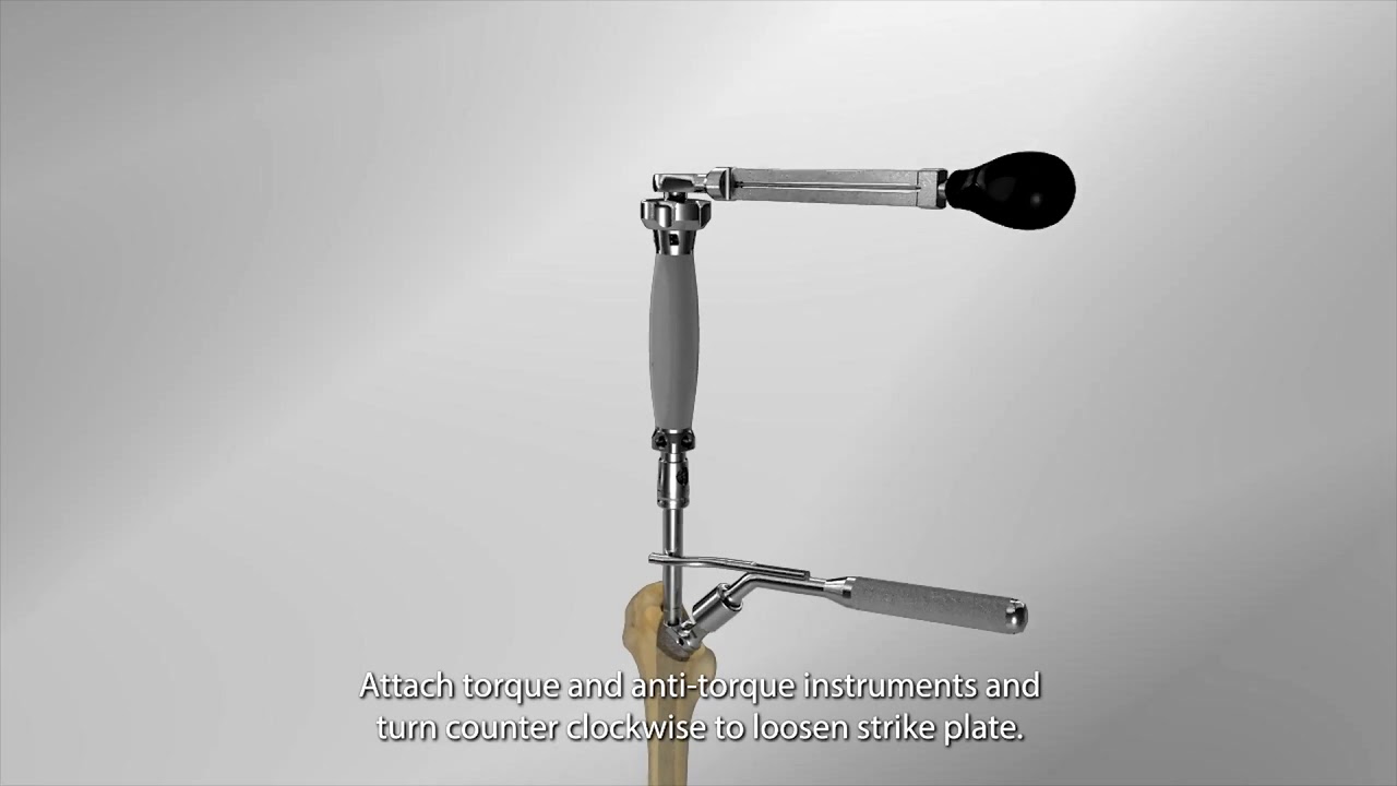 Arcos&reg; Modular Femoral Revision System - In-Femur Assembly