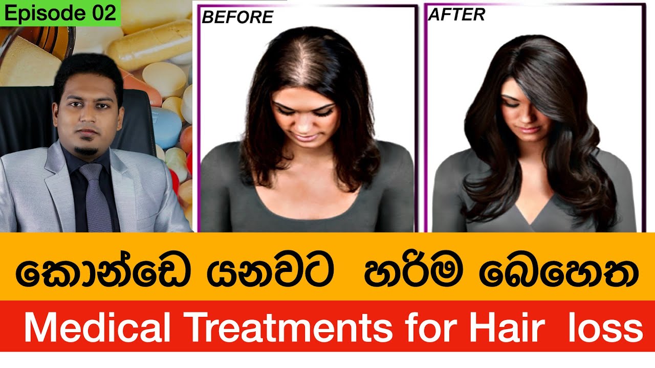 හිස්කෙස් වැටීමට කෙරෙන වෛද්‍ය ප්‍රතිකාර | Medical Treatments for Hair fall By Nutritionist Hiroshan