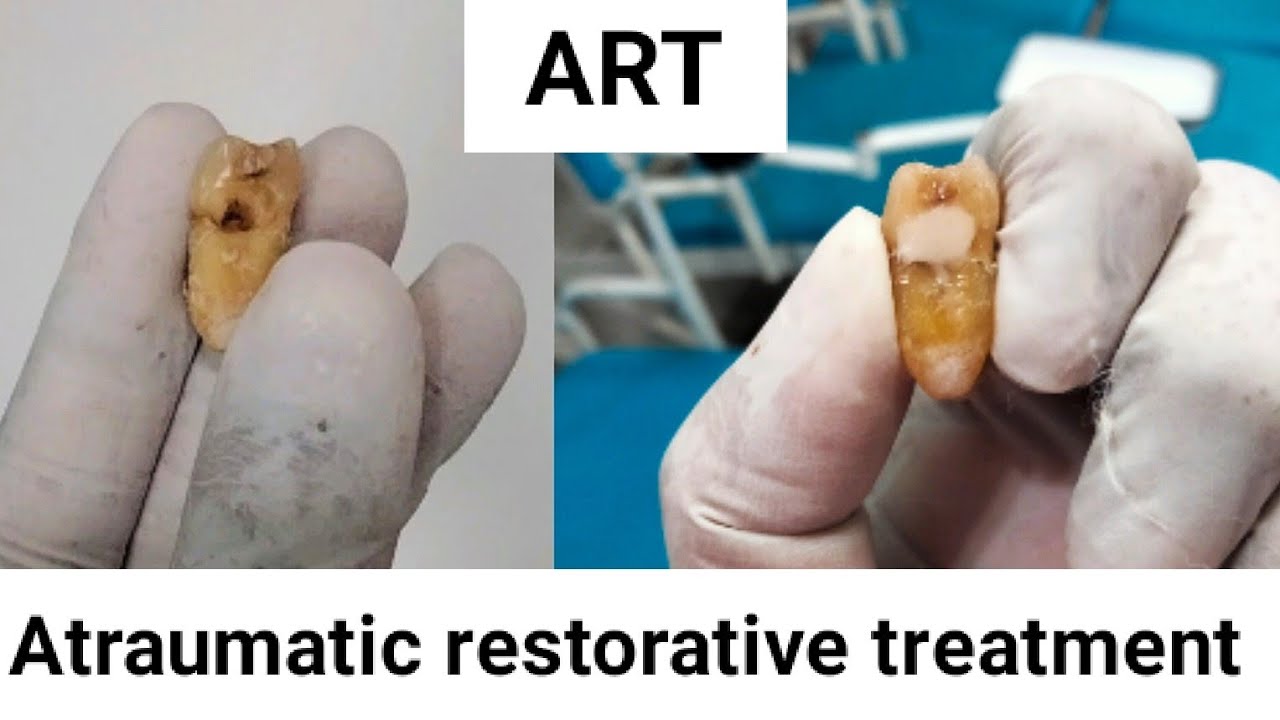 Atraumatic restorative treatment session// community dentistry