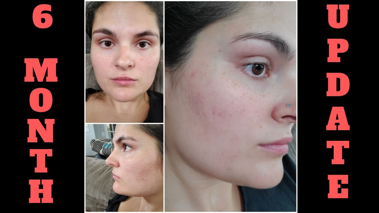 Spironolactone for Acne! 6 MONTH UPDATE! - Episode #17
