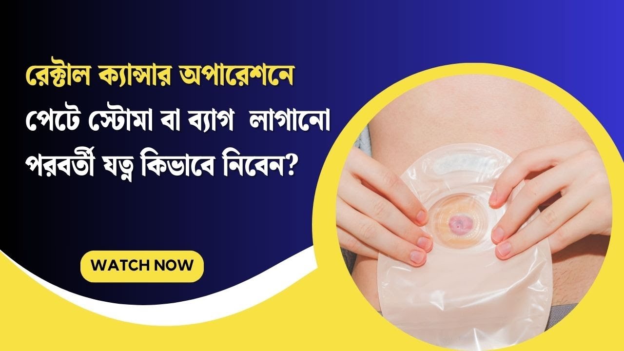 রেক্টাল ক্যান্সার অপারেশনে পেটে স্টোমা বা ব্যাগ  লাগানো পরবর্তী যত্ন কিভাবে নিবেন?