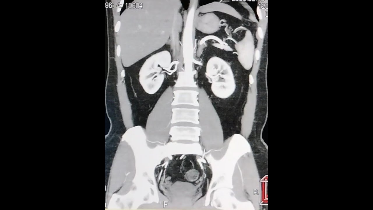 CT advanced postprocessing and reformatting techniques for angiography exam