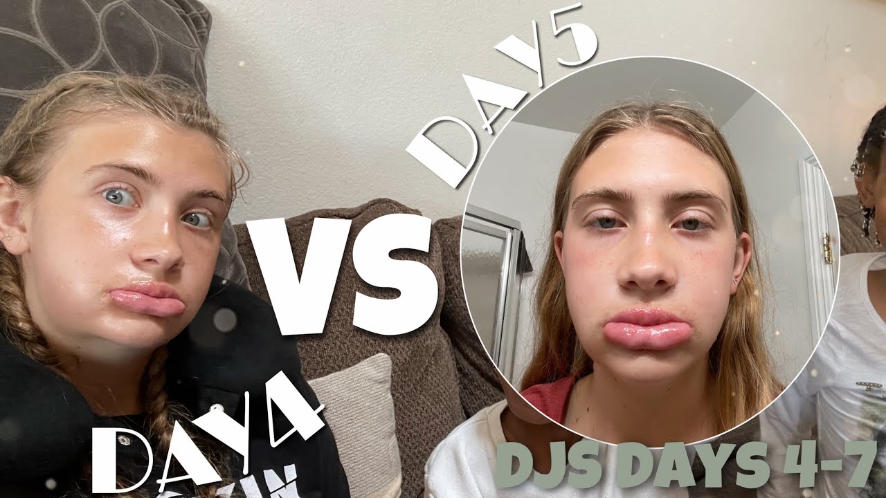 Days 4-7 Post-Op | DOUBLE JAW SURGERY | the reality of recovery