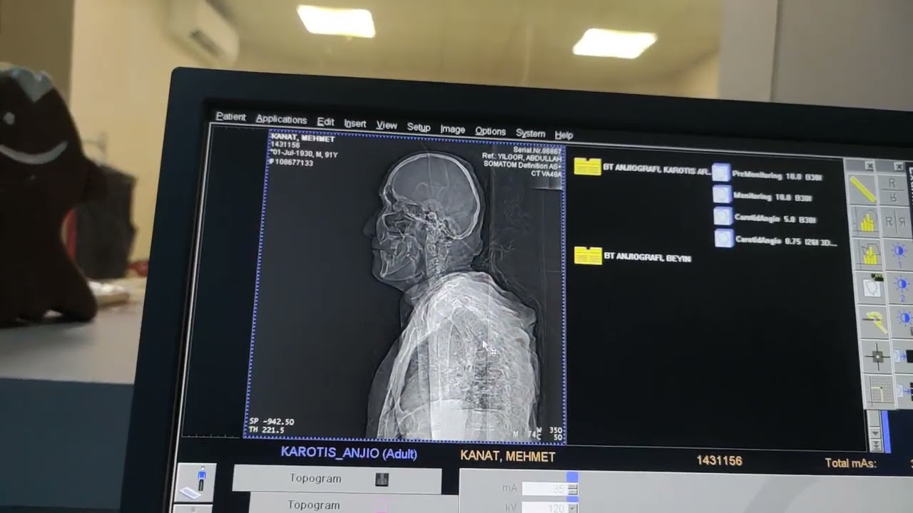 Beyin Boyun Anjio Tomografi çekimi nasıl olur? Beyin Boyun Anjio ne kadar sürer. beyin tomogrofi