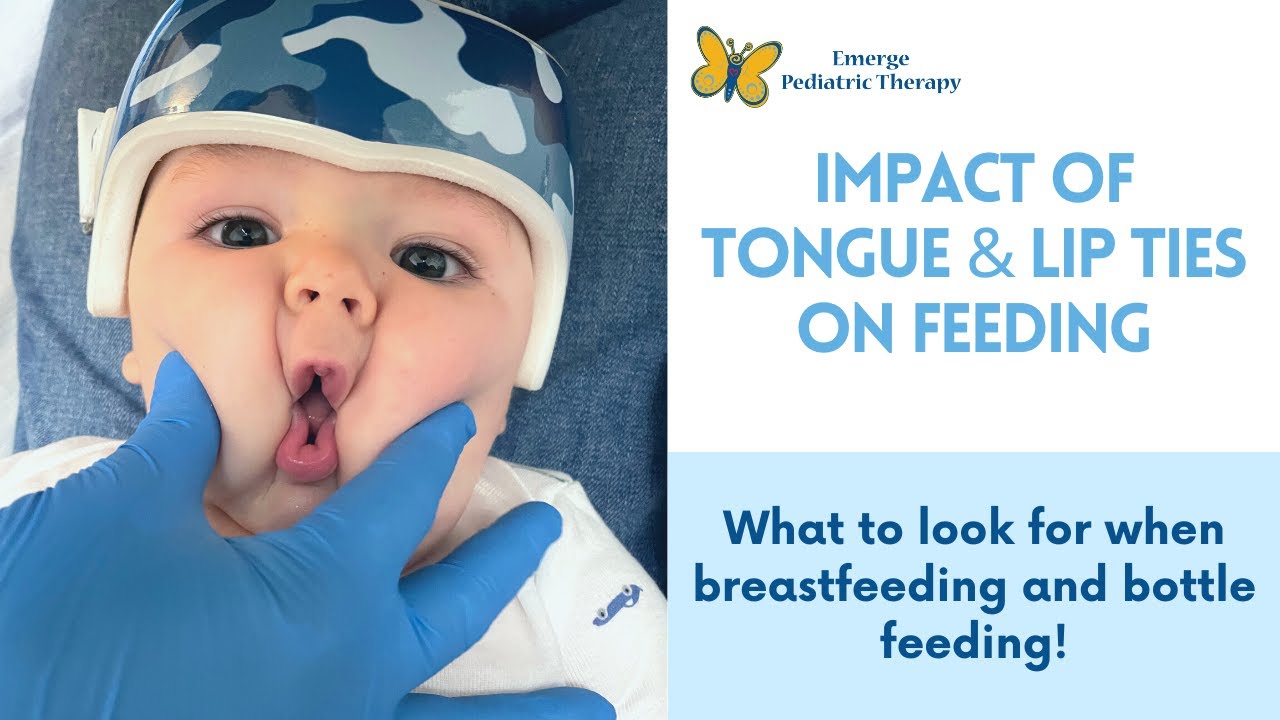 Tongue & Lip Ties: what to look for when feeding