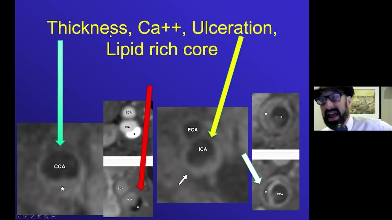 Imaging of CNS Vasculitis with Dr. David Yousem | Medality / MRI Online Radiology Course
