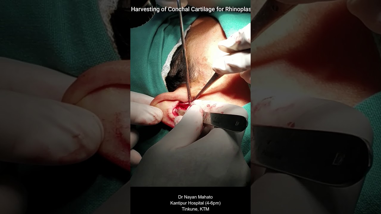 Harvesting of Conchal Cartilage for Rhinoplasty