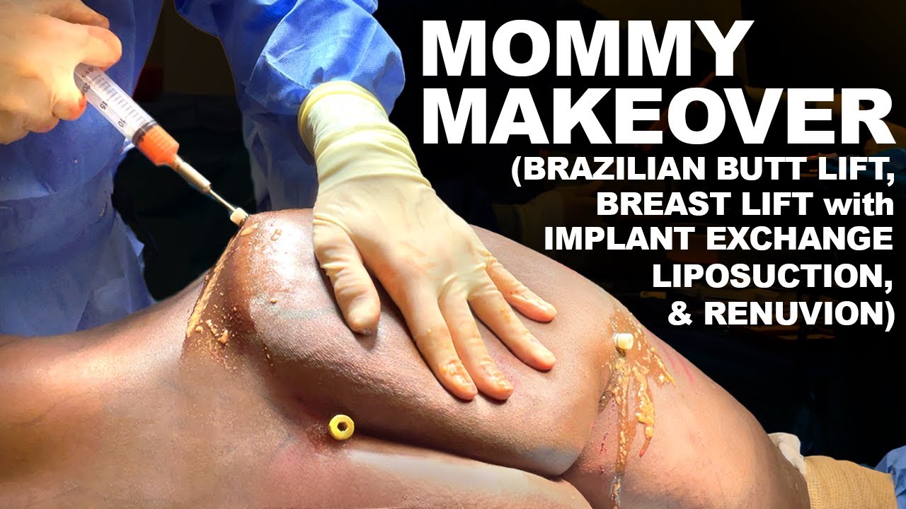 Mommy Makeover - Dr. Paul Ruff | West End Plastic Surgery